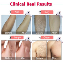 Charger l&#39;image dans la galerie, Laser Hair Removal for Women &amp; Men
